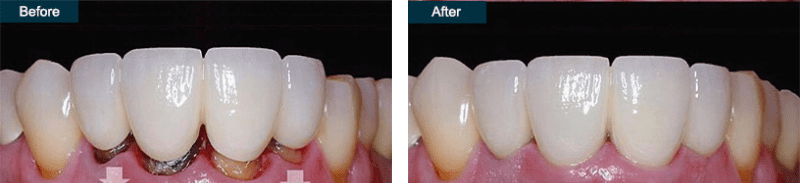 Dental Bridge
