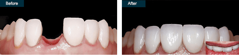 Dental Implants
