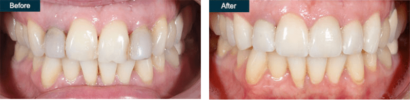 Dental Fillings
