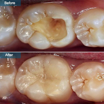 before after Cavity Filling Composite Fillings