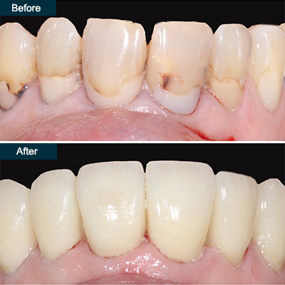 before after Dental Veneers Brooklyn NY