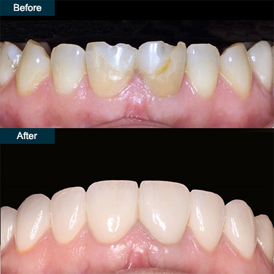 before after Dental Veneers (press on teeth veneers)