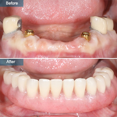 before after Denture Implants (Dental Implant Dentures)