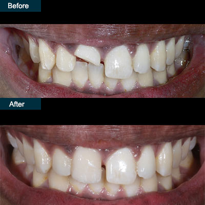 before after dental anterior crowns brooklyn