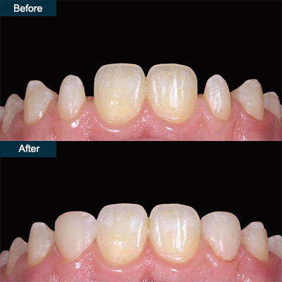 before after dental bonding 2