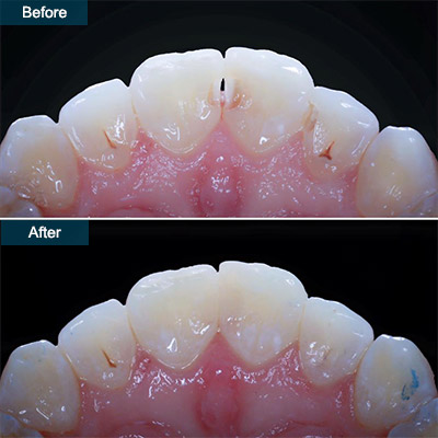 Composite bonding vs veneers: costs and which is best for teeth?