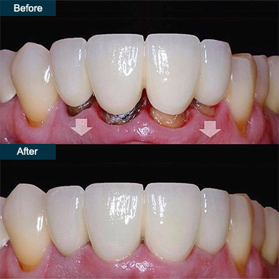 dental bridge before and after