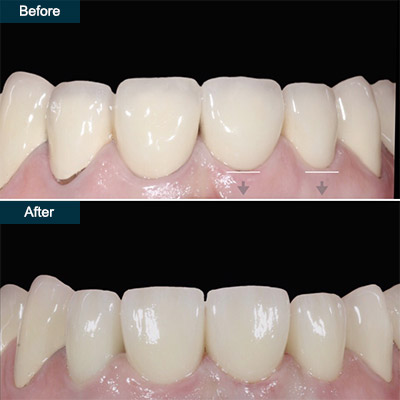 before after dental crowns