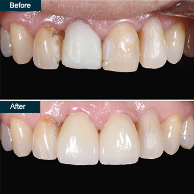 before after dental crowns brooklyn ny