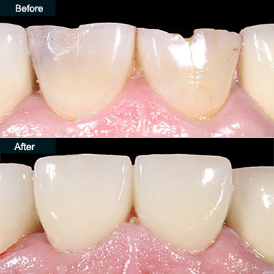 before after dental crowns brooklyn ny