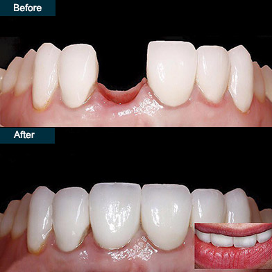 tooth implant before after