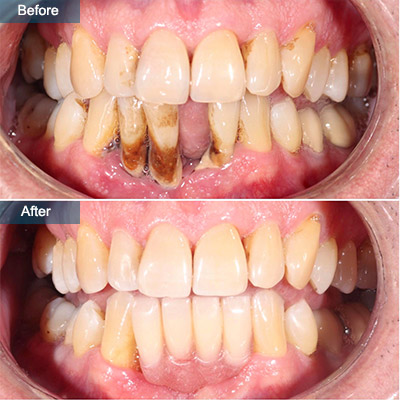 before after dental implants 3