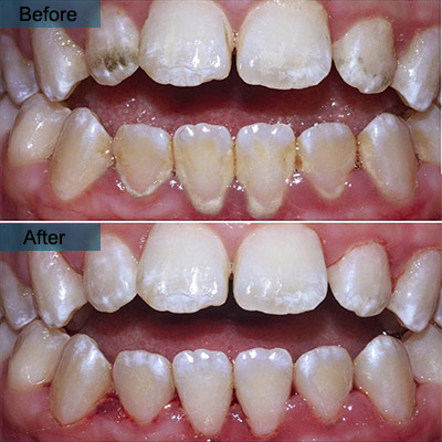 before after deep teeth cleaning