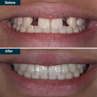 Before After Dental Implant Crowns