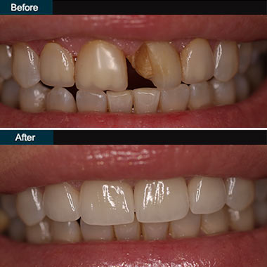 Dental Veneers Brooklyn NYC | before after 3