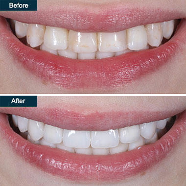 before-after-dental-veneers-Brooklyn-NYC-07
