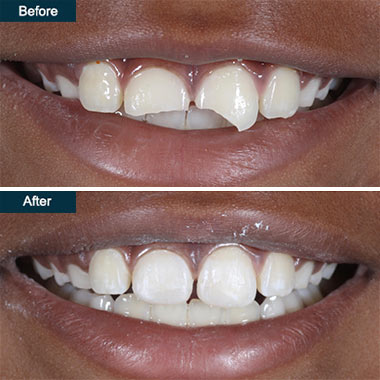 Before & After Photos, Cracked Tooth Repair Gallery