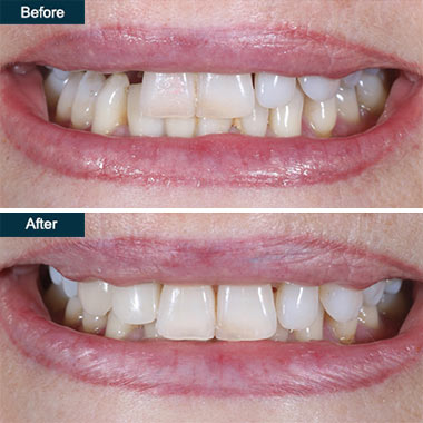 before-after-temporary-implant-crowns-Brooklyn-NYC-01