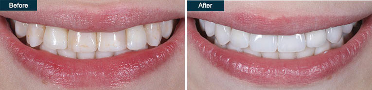 Composite Veneers Before and After Composite Veneers Before and After Brooklyn Cosmetic Dentistry