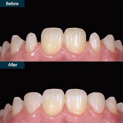 bonding dentistry