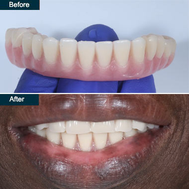 denture implants Brooklyn