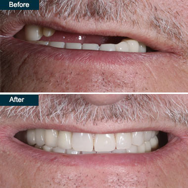 dentures implant Brooklyn