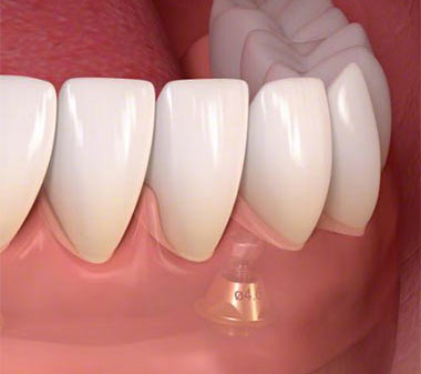 single tooth implants placement in Brooklyn