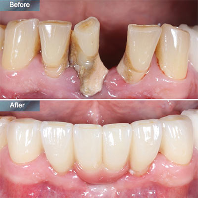 before after Dental Bridge Brooklyn NYC