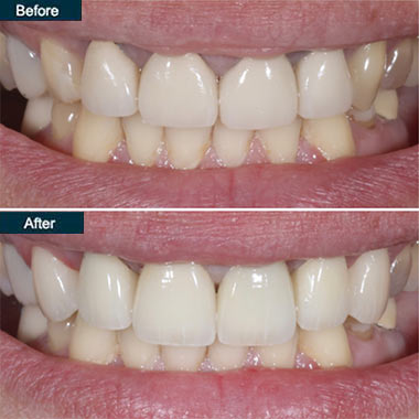 before after Denture Brooklyn NYC