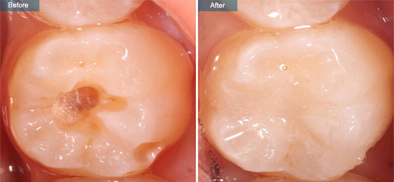 Composite Fillings | Cosmetic Dentistry in Brooklyn