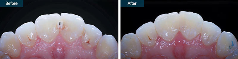 Dental Bonding (Cosmetic Teeth Bonding)