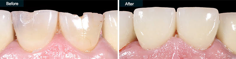 Dental Crowns Before & After | Cosmetic Dentistry in Brooklyn