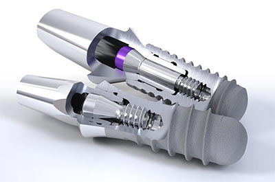 Dental Implants Posts