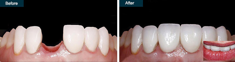 Single Tooth Implants Before & After