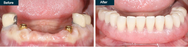 Denture Implants Before & After | Denture Implants in Brooklyn