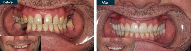 Full Mouth Dental Implants in Brooklyn