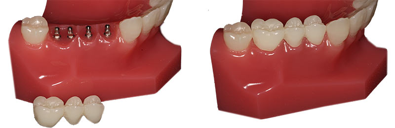 Mini Dental Implants