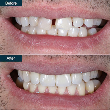 press on teeth veneers brooklyn