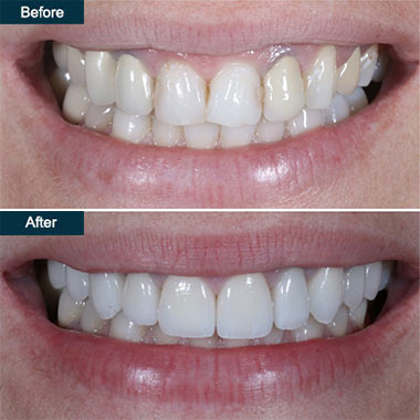 Porcelain Veneers Brooklyn