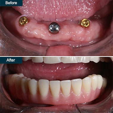 before after Denture Implants (Dental Implant Dentures)