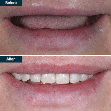 Temporary Broken Teeth Repair, Temporary Convenient Tooth Filling