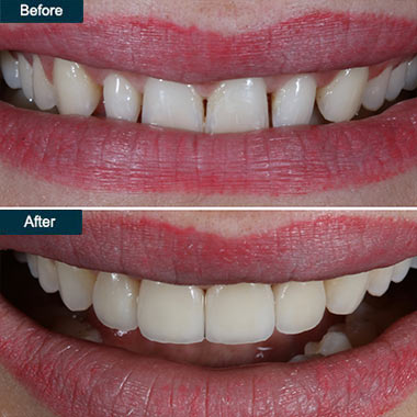 dental veneers brooklyn ny