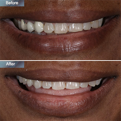 dental bridge before after