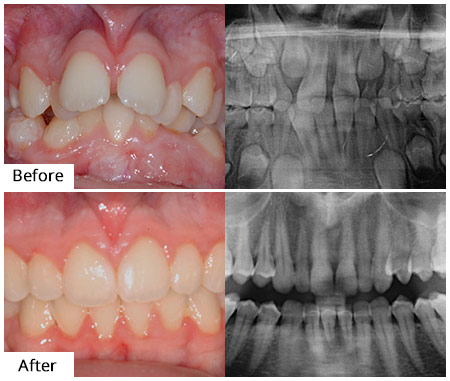Before & After Emergency Oral Surgery  in Brooklyn NY