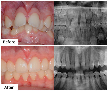 all on 4 vs dentures