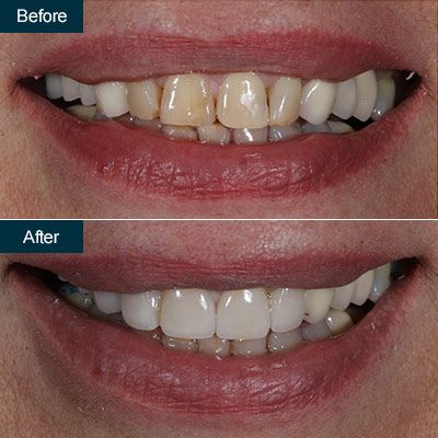 Dental Veneers from Dental Associates