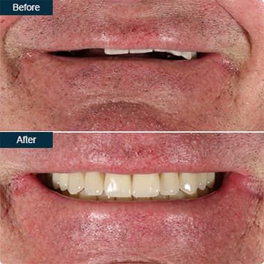 Before and After Implant Dentures