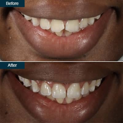 Dental Bonding Before and After