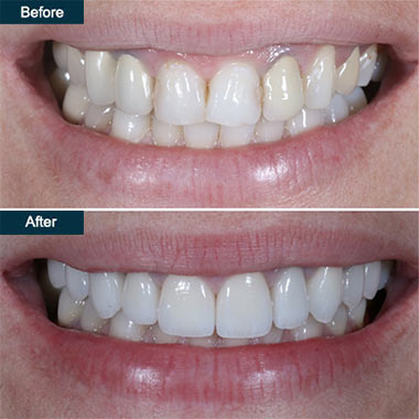 Teeth Lumineers Brooklyn NYC | Before and After Lumineers