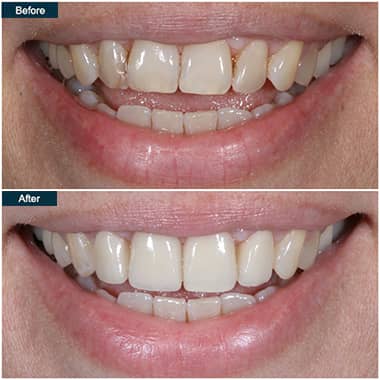 Before and after Porcelain Veneers